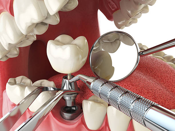 Best Emergency Wisdom Teeth Removal in Exander City, AL