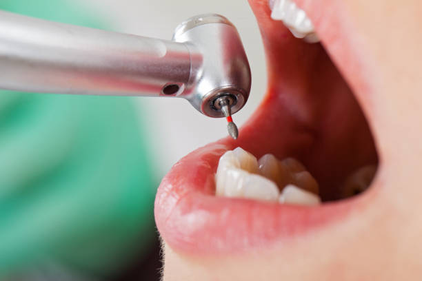 Best Emergency Treatment for Toothache in Exander City, AL